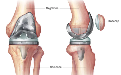 Journey of a new knee