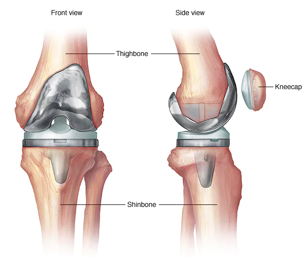 Journey of a new knee